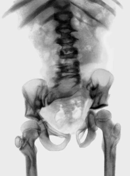 Рис. 44. Рентгенограмма тазобедренных суставов при <a href=