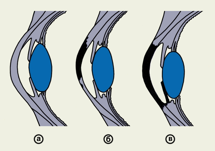 Рис. 1. Схематическое изображение поверхностного и глубокого кератита: а — поверхностный кератит; б — глубокий кератит с изъязвлениями; в — кератоиридоциклит без изъязвления