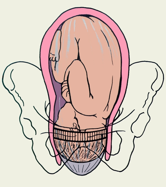 Рис. 3. Схематическое изображение расположения плода в матке в конце периода раскрытия ее шейки: полное раскрытие шейки матки, головка плода располагается во входе в малый таз, <a href=