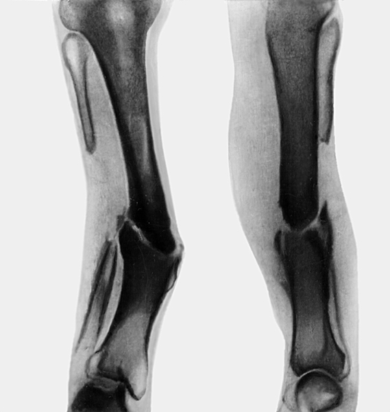 Рентгенограммы голени с гипертрофическим ложным суставом большеберцовой и дефектом малоберцовой кости: слева — прямая, справа — боковая проекции
