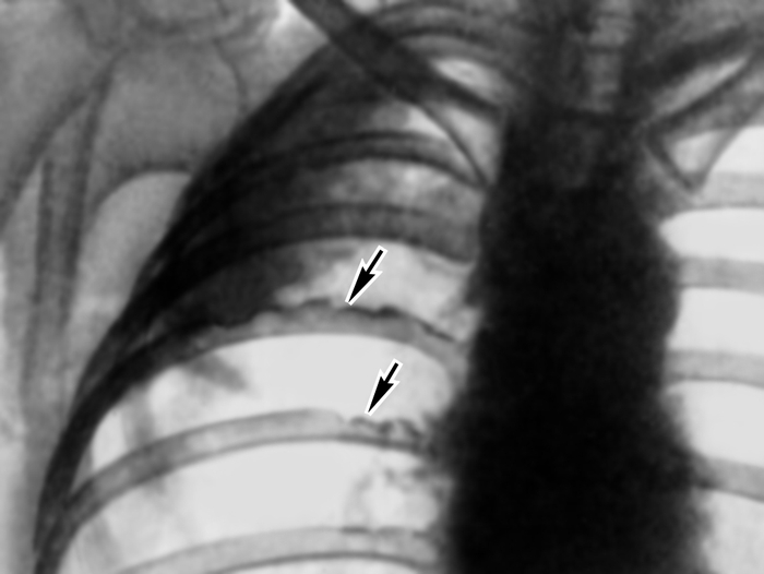 Рис. 10. Фрагмент прямой рентгенограммы органов грудной клетки больного со злокачественной опухолью (мезотелиомой) плевры: видна пристеночная тень опухоли в правой половине грудной клетки, стрелками указана краевая <a href=