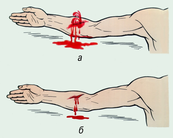 Рис. 1. Виды кровотечения: а — артериальное, б — венозное