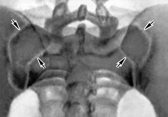 Рис. 3. Рентгенограмма крестцово-подвздошных суставов в норме (прямая задняя проекция): стрелками указаны передние и задние края суставных щелей