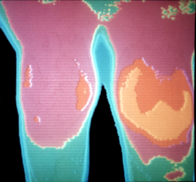 Рис. 14. Термограмма коленных суставов (прямая проекция) при левостороннем гемартрозе: резко увеличена теплопродукция в области левого коленного сустава