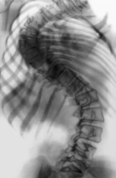 Рис. 18а). Рентгенограмма позвоночника (прямая проекция) при правостороннем грудном сколиозе IV степени до операции