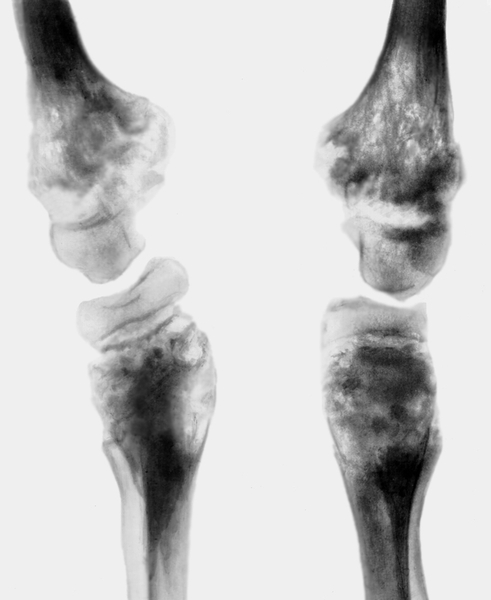 Рис. 22. Рентгенограмма коленных суставов при метафизарной хондродисплазии Янсена: на значительном протяжении нарушена оссификация метафизов, имеются очаговые дефекты костной ткани; зоны роста в дистальных концах бедренных костей резко расширены, контуры эпифизов и метафизов неровные, кости голени искривлены