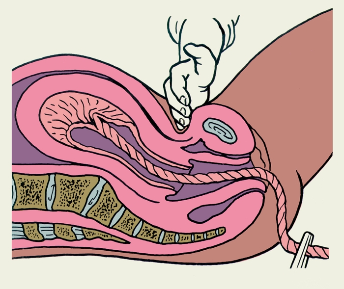 Рис. 11а). Схематическое изображение определения отслойки плаценты по признаку Кюстнера —Чукалова: при надавливании ребром ладони на брюшную стенку роженицы пуповина неотделившейся плаценты втягивается во влагалище