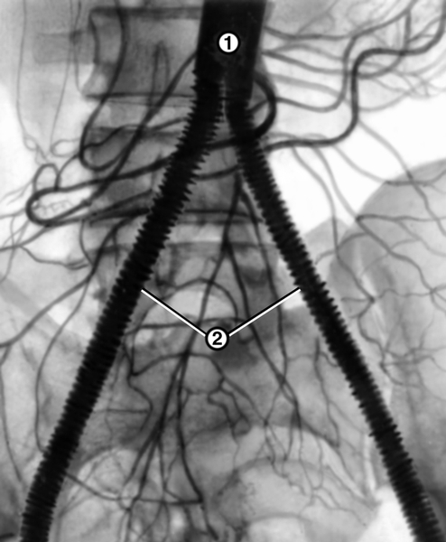 Рис. 3. Аортограмма больного с синдромом Лериша после резекции брюшной части аорты с бифуркационным протезированием: 1 — аорта; 2 — сосудистый <a href=