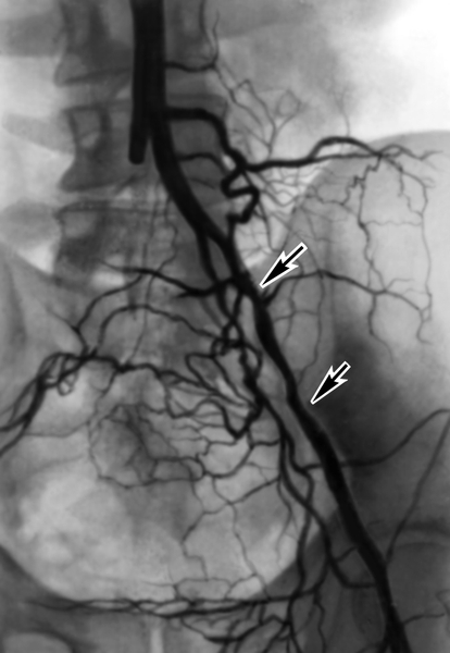 Рис. 2. Аортограмма больного с синдромом Лериша, обусловленном атеросклеротическим поражением бифуркации аорты и общих подвздошных артерий: окклюзия правой общей подвздошной артерии, участки стенозирования левой наружной подвздошной артерии указаны стрелками
