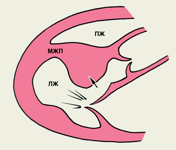 Рис. 4б). Поясняющая схема к двухмерной эхокардиограмме больного с обструктивной гипертрофической кардиомиопатией: ПЖ — правый желудочек, МЖП — межжелудочковая перегородка, ЛЖ — левый желудочек. Стрелкой на схеме указано место локального утолщения базальной части МЖП, суживающее выходной тракт левого желудочка