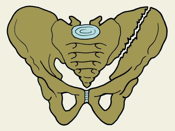 Рис. 7. Схематическое изображение перелома подвздошной кости