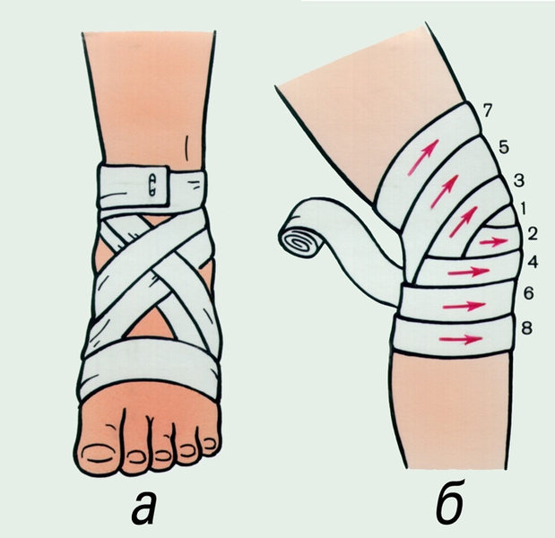 Рис. 9. Крестообразные повязки на голеностопный (а) и на коленный (б) <a href=