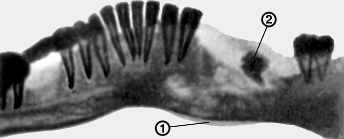 Рис. 7. Панорамная рентгенограмма нижней челюсти при хроническом остеомиелите: 1 — периостальная <a href=