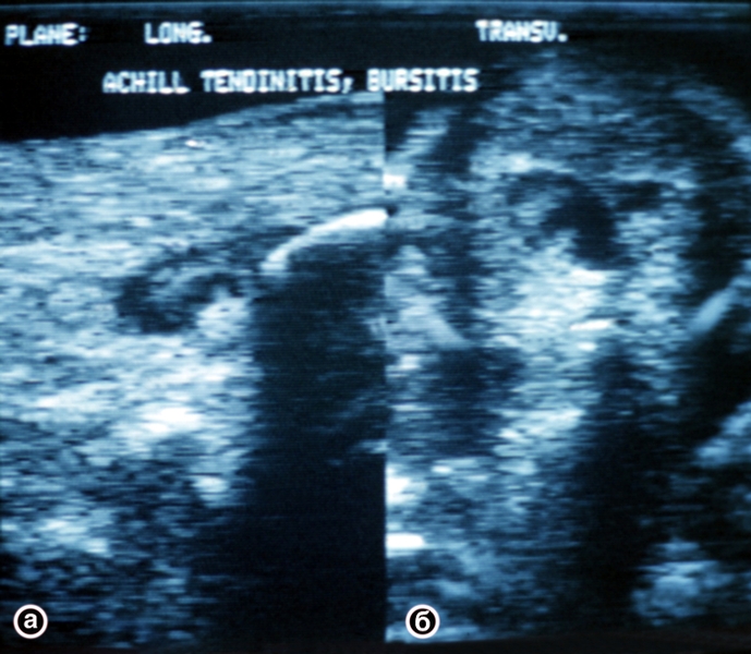 Рис. 2. Ультрасонограммы пяточного (ахиллова) сухожилия (а — продольный; б — поперечный срезы): в толще сухожилия видна обширная зона сниженной эхогенности, обусловленная кистой