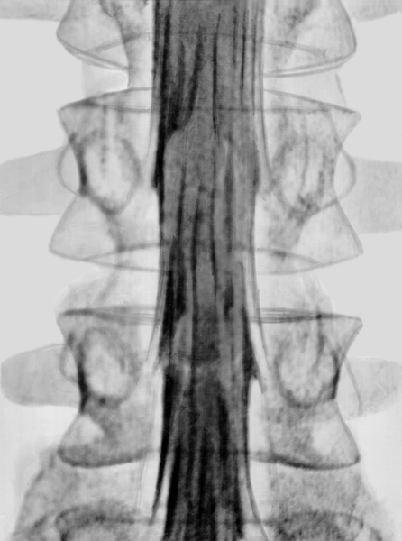 Рис. а). Миелограмма в норме: стрелками указан дефект заполнения субарахноидального пространства рентгеноконтрастным веществом