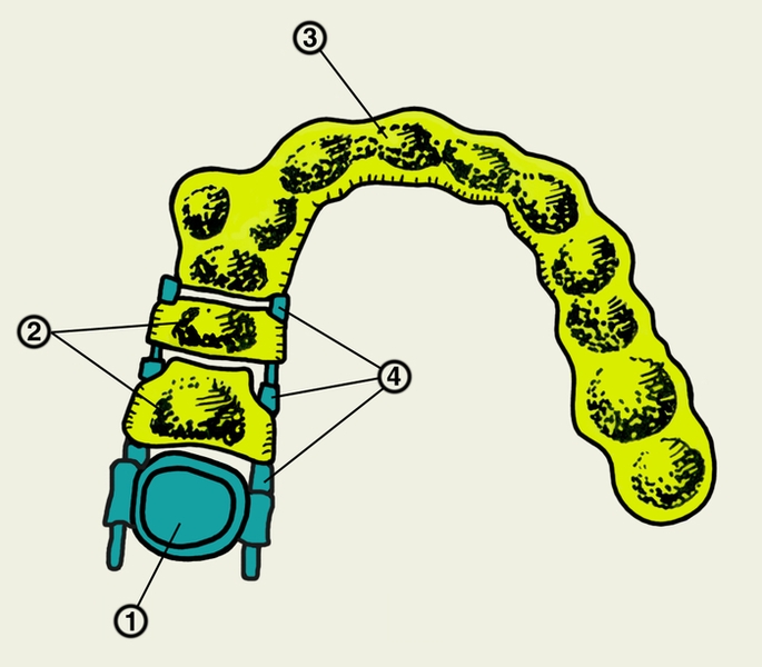 Рис. 9. Схематическое изображение каппового аппарата Каламкарова: 1 — металлическая коронка на перемещаемом зубе; 2 — сегменты каппы для последовательного перемещения зубов; 3 — пластмассовая каппа; 4 — отрезки проволочных дуг Энгла