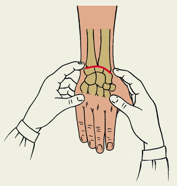 Рис. 5. Схема определения положения костных выступов в области лучезапястного сустава: <a href=