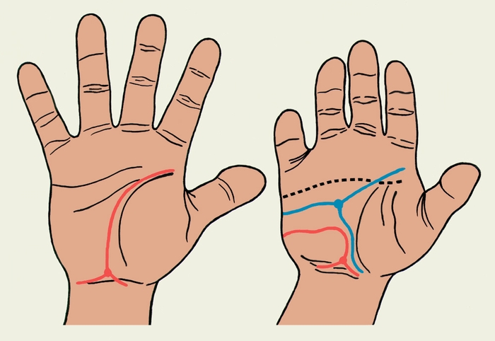 Рис. 2. Схематическое изображение ладонной поверхности кисти здорового ребенка (слева) и ребенка того же возраста с болезнью Дауна: <a href=