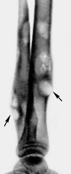 Рис. 1. Рентгенограмма костей голени ребенка 13 лет при гуммозном периостите (боковая проекция): гладкие, ровные периостальные наслоения вокруг гумм (указаны стрелками)