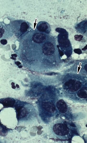 Рис. 9. Цитограмма плеврального экссудата при злокачественной опухоли (мезотелиоме) плевры: видны крупные опухолевые без четких границ клетки (указаны стрелками); ×900