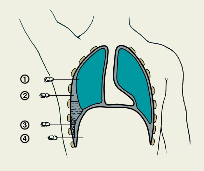 Схематическое изображение возможных вариантов неправильного введения иглы при плевральной пункции: 1 — <a href=