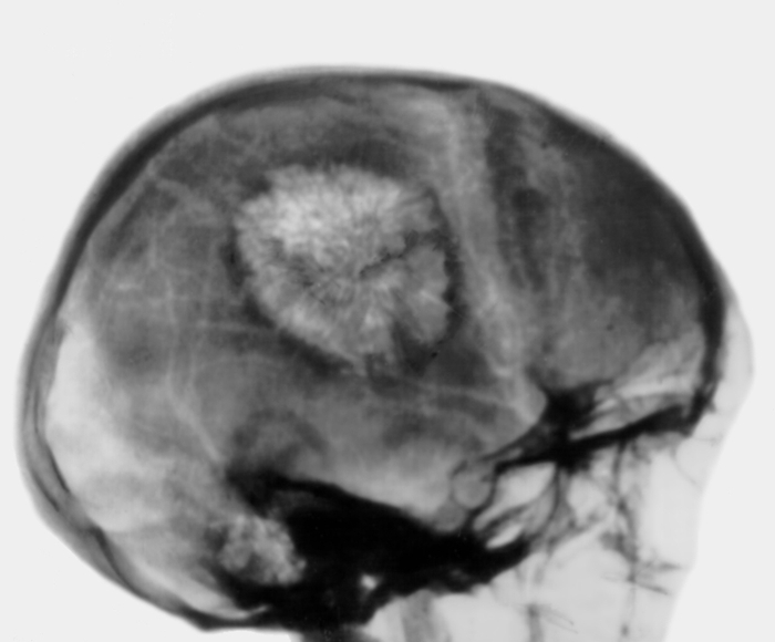 Рис. 6. Боковая рентгенограмма черепа больного при капиллярной гемангиоме теменной кости: имеется круглый очаг изменения структуры кости с типичным лучистым груботрабекулярным рисунком и краевым остеосклеротическим ободком