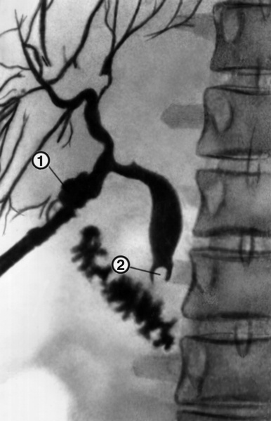 Рис. 1. Фистулограмма неполного наружного желчного свища: 1 — свищевой канал, контрастированный через дренажную трубку; 2 — камень в общем желчном протоке
