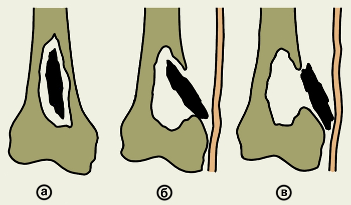 Рис. 1. Схематическое изображение вариантов расположения секвестров при остеомиелите: а — внутри костной полости; б — частично вне полости (перфорирующий секвестр); в — вне полости