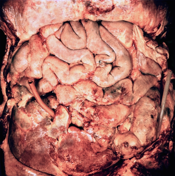 Рис. 1б). Макроскопическая картина вскрытой брюшной полости при гнойном перитоните: вздутые петли кишечника спаяны между собой, видна резиновая дренажная трубка