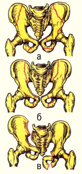 Рис. 1. Схема костей таза: а — перелом костей таза без нарушения целости тазового кольца; б — перелом с нарушением целости тазового кольца; в — схема сложного переломовывиха костей таза