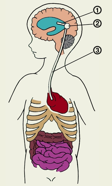 Рис. 5. Схема вентрикулоатриального шунтирования при гидроцефалии: 1 — <a href=
