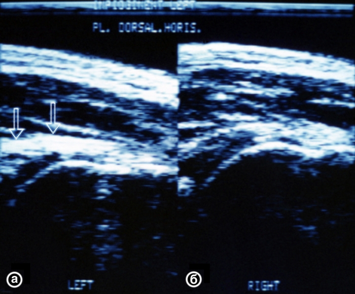 Рис. 18. Ультрасонограммы плечевых суставов (задний горизонтальный срез) при плечелопаточном периартрозе (а) и в норме (б): значительно увеличена эхогенность сухожилия в зоне поражения (указана стрелкой)