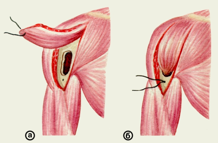 Рис. 14. Схематическое изображение мышечной пластики остеомиелитической полости плечевой кости: а — мобилизован мышечный <a href=