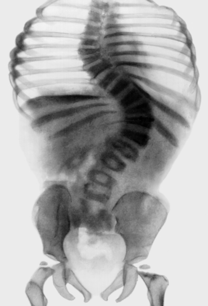 Рис. 30. Рентгенограмма тазобедренных суставов с частью позвоночника при дисплазии Диггве — Мельхиор — Клаузена: отмечаются сколиоз, сужение таза, уплощение головок бедренных костей, зоны роста их шеек расположены горизонтально, шейки бедренных костей сужены. Имеется соха valga