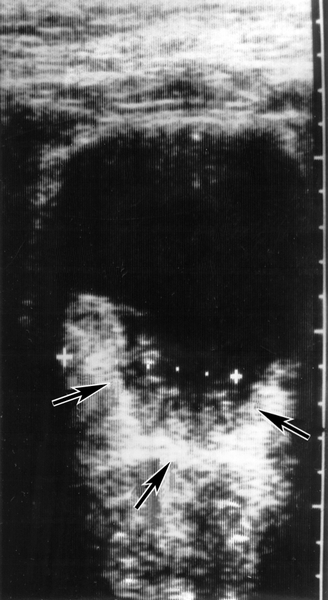 Рис. 5. Ультразвуковая томограмма при раке мочевого пузыря: стрелками указана <a href=