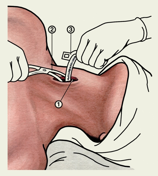 Рис. 2. Схема расширения коникостомы и введения в нее трахеотомической трубки: 1 — коникостома; 2 — <a href=
