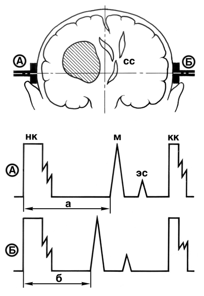 Рис. 2. Схематическое изображение эхоэнцефалограмм при объемном образовании в правом полушарии головного мозга: вверху — фронтальный разрез головы с расположенными в височных областях ультразвуковыми датчиками (А, Б), ниже размещены эхоэнцефалограммы (А — правая, Б — левая); СС — срединные структуры (третий желудочек головного мозга), М — эхосигнал от срединных структур мозга (М-эхо), ЭС — эхосигнал от различных несрединных структур мозга, НК — начальный комплекс, КК — конечный комплекс; в норме расстояние а на эхоэнцефалограмме, полученной при установке датчика справа, равно расстоянию б на кривой, полученной при установке датчика слева; при патологии (объемное образование в правом полушарии головного мозга заштриховано) расстояние а на правой (верхней) кривой увеличено за счет смещения срединных структур головного мозга, а направление смещения М-эха противоположно локализации патологического очага