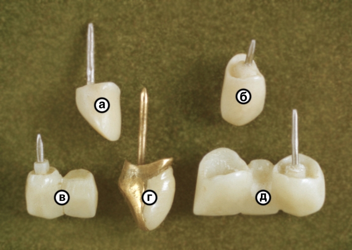 Рис. 5. Различные виды штифтовых зубов: а — штифтовой зуб по Ильиной — Маркосян; б — обычный шифтовой зуб из пластмассы; в — штифтовой зуб как опора консольного протеза; г — штифтовой зуб по Ригмонду; д — штифтовой зуб как опора мостовидного протеза