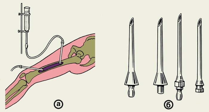 Рис. 15. Схематическое изображение промывания полости в бедренной кости после секвестрэктомии в послеоперационном периоде (а) и костные иглы для промывной системы (б)