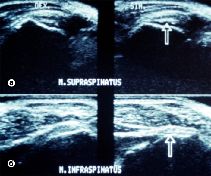 Рис. 3. Ультрасонограммы надостных (а) и подостных (б) мышц при частичном повреждении коротких ротаторов левого плеча; места повреждений указаны стрелками