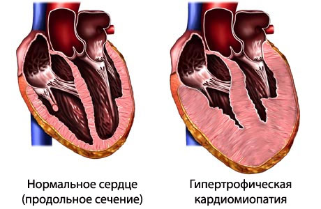 Кардиомиопатия гипертрофическая