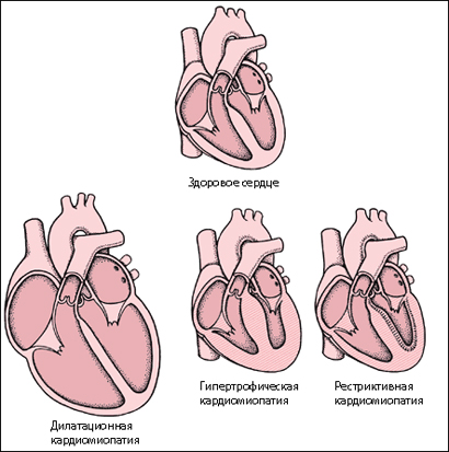 Кардиомиопатия рестриктивная