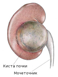 Киста почки простая