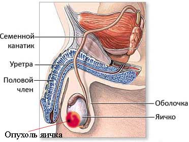 Опухоли яичек