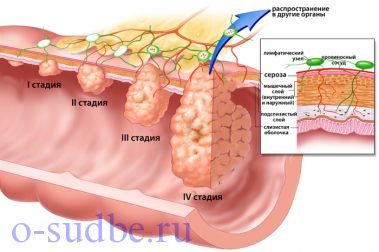 Опухоль, стадии